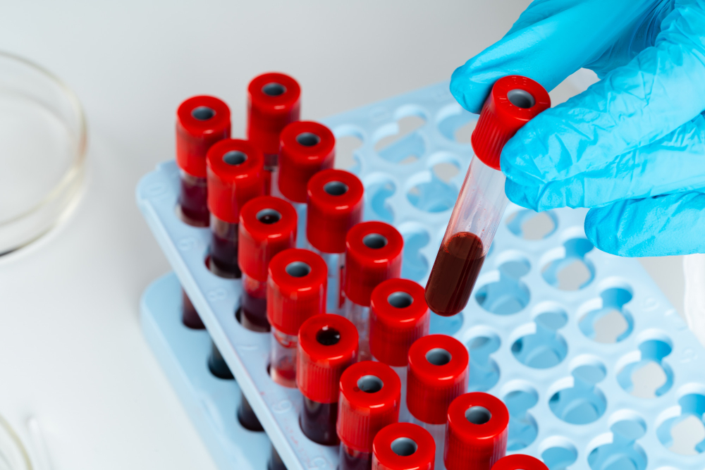 doctor s hands in blue gloves keep test tube with a blood